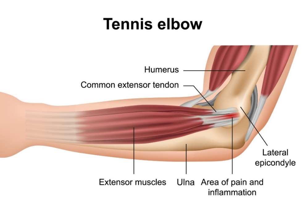 Tennis elbow (epikondilitis lateral): tulang-tulang sendi siku, ekstensor otot-otot lengan bawah, epikondilus lateral, dan lokasi nyeri primer.