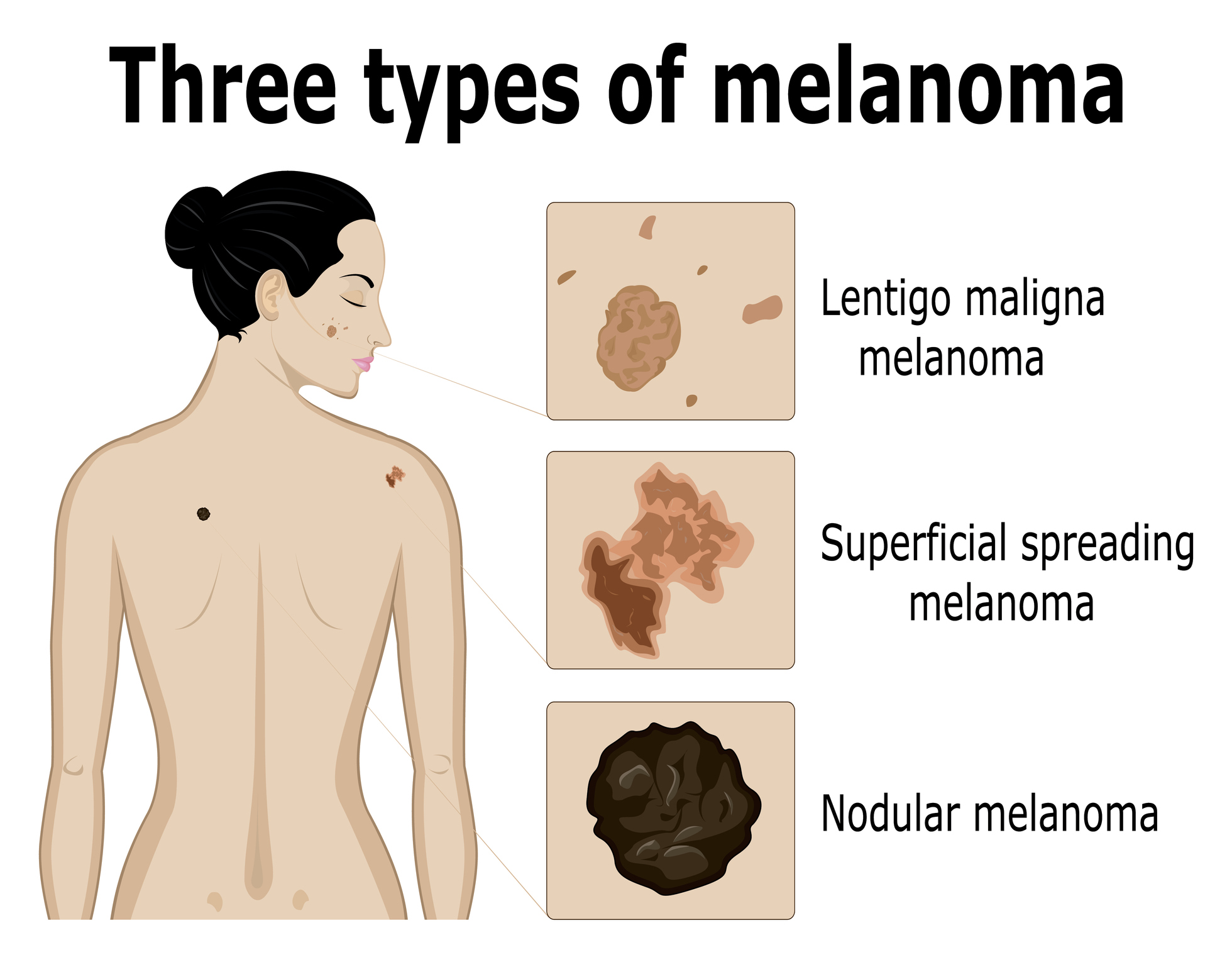 Pencitraan tiga jenis melanoma