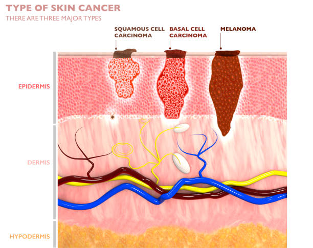 Jenis-jenis tumor kulit, penetrasi ke dalam kulit - karsinoma sel skuamosa, basalioma, dan melanoma