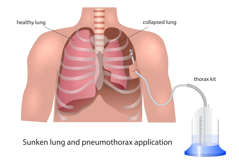 Visualisasi drainase pleura pada pneumotoraks: paru-paru yang sehat, paru-paru yang kolaps, dan perangkat drainase