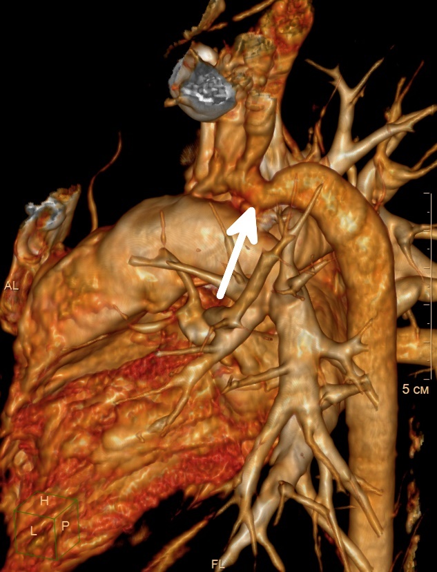 Visualisasi koarktasio (penyempitan) aorta pada bagian pembuluh darah jantung yang turun.