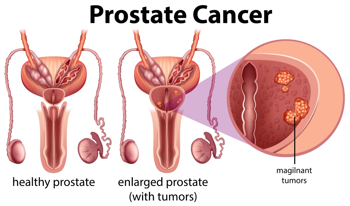 Kanker prostat. Prostat sehat dan prostat yang membesar dengan tumor