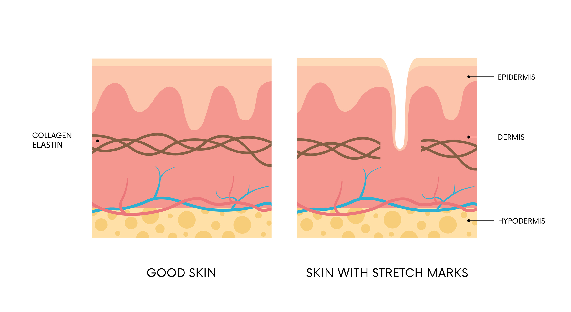 Model animasi: perbandingan kulit yang sehat dan kulit yang rusak akibat stretch mark