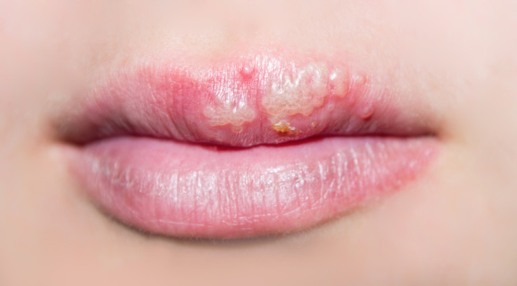 herpes di bibir atas