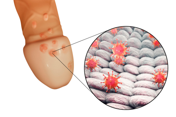 herpes genital pada penis dan virus herpes pada tingkat mikroskopis