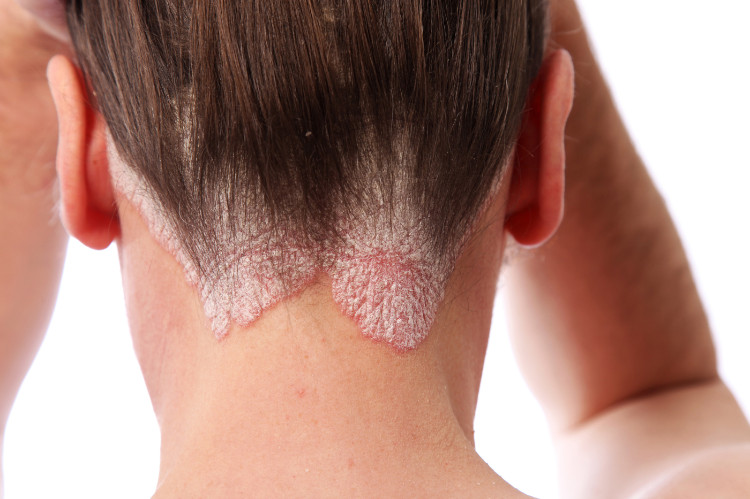 psoriasis bagian belakang leher