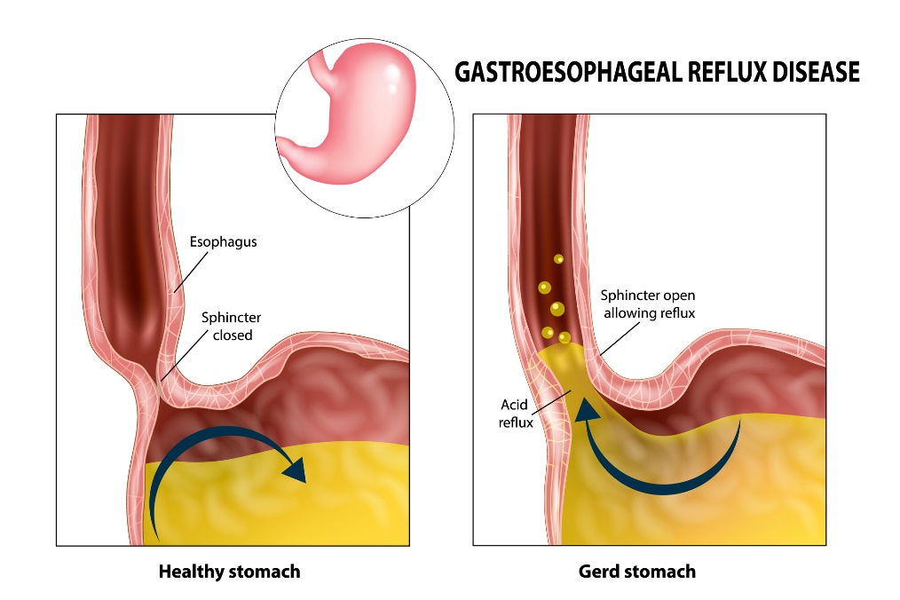 Refluks gastroesofagus: kerongkongan, sfingter, lambung, dan asam lambung