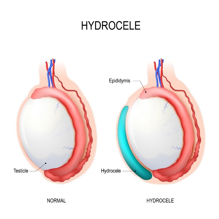 Hidrokel: Testis (buah zakar), epididimis, Hidrokel (cairan yang terkumpul)