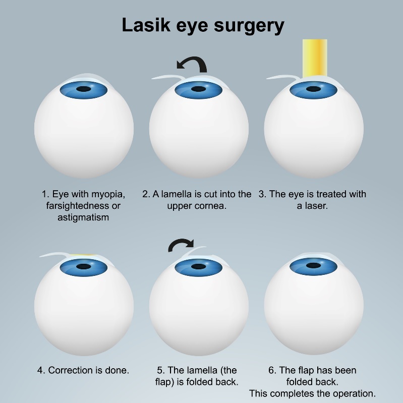 Operasi laser mata LASIK - metode subsurface. Prosedur dengan flap/flap tanpa merusak ujung saraf.