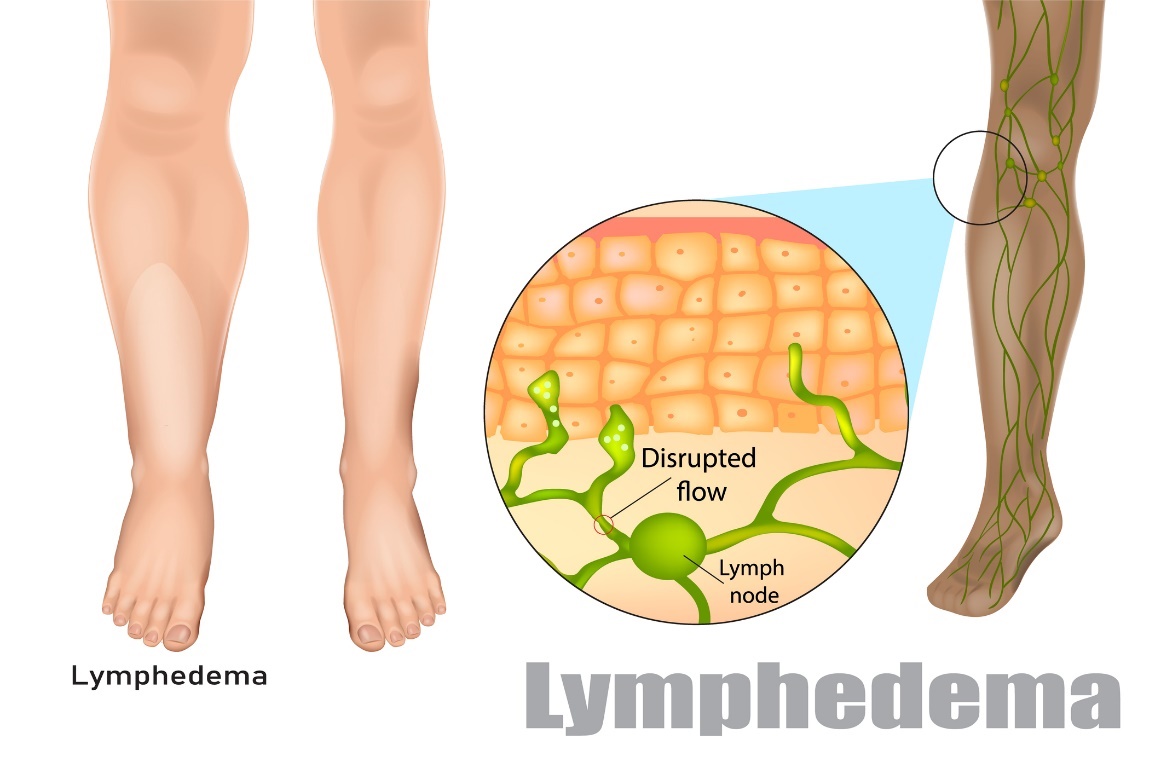 Limfedema