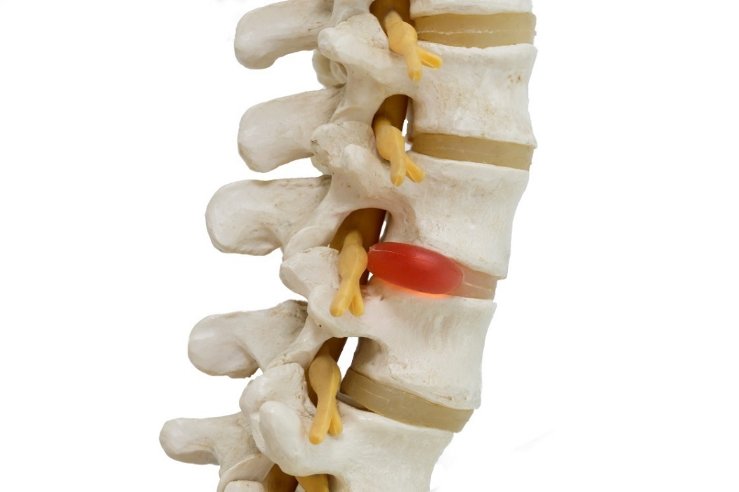 Representasi anatomi model 3D tulang belakang, diskus intervertebralis, dan diskus hernia dengan kompresi saraf