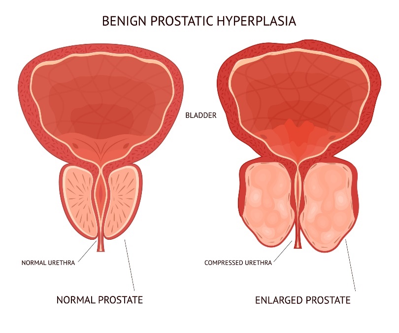 Pembesaran prostat yang jinak (tidak berbahaya). kandung kemih, jaringan fisiologis dan pembesaran organ prostat.