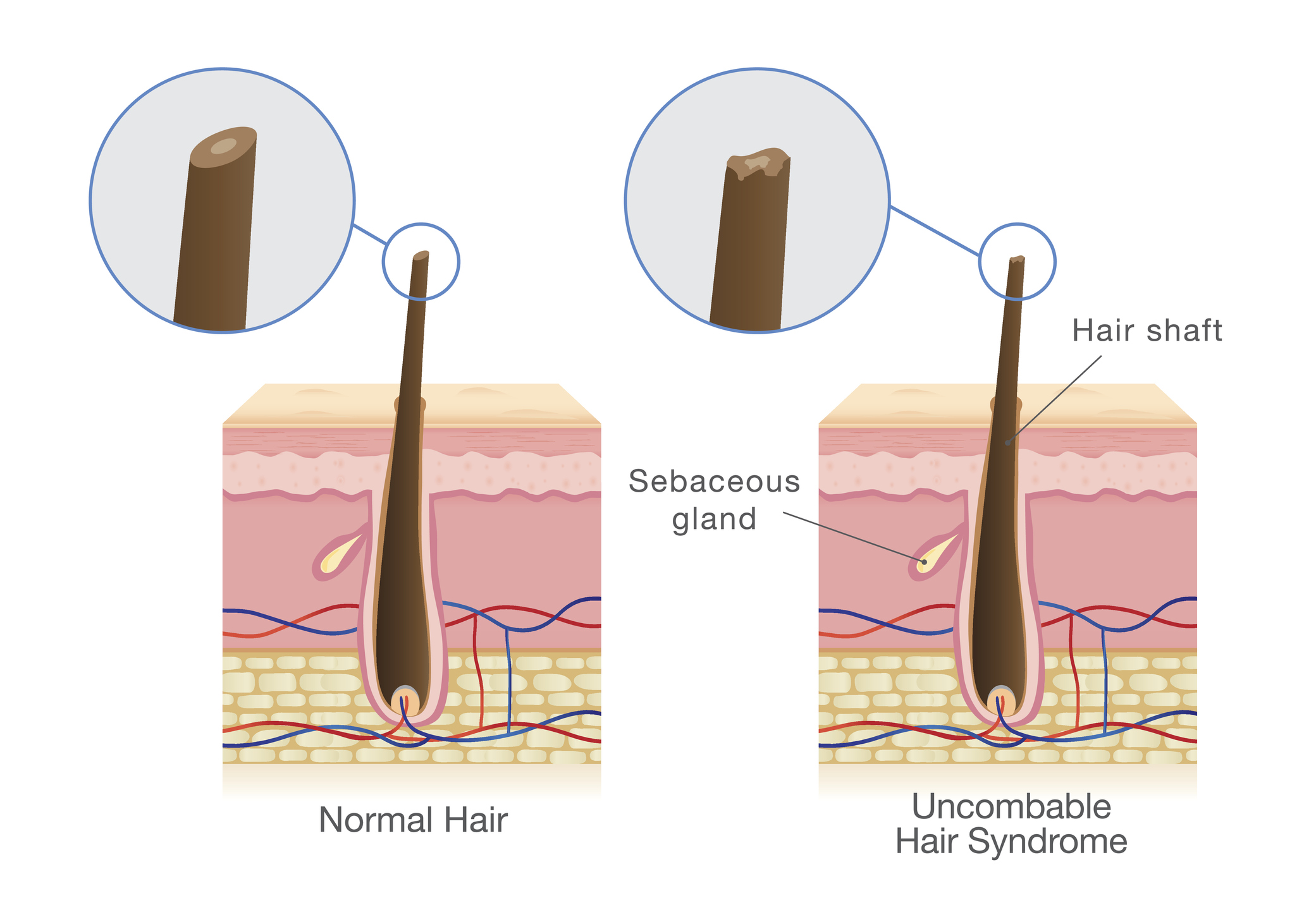 Perbandingan: rambut normal di sebelah kanan dan rambut dengan sindrom rambut yang tidak dapat diatur di sebelah kiri.