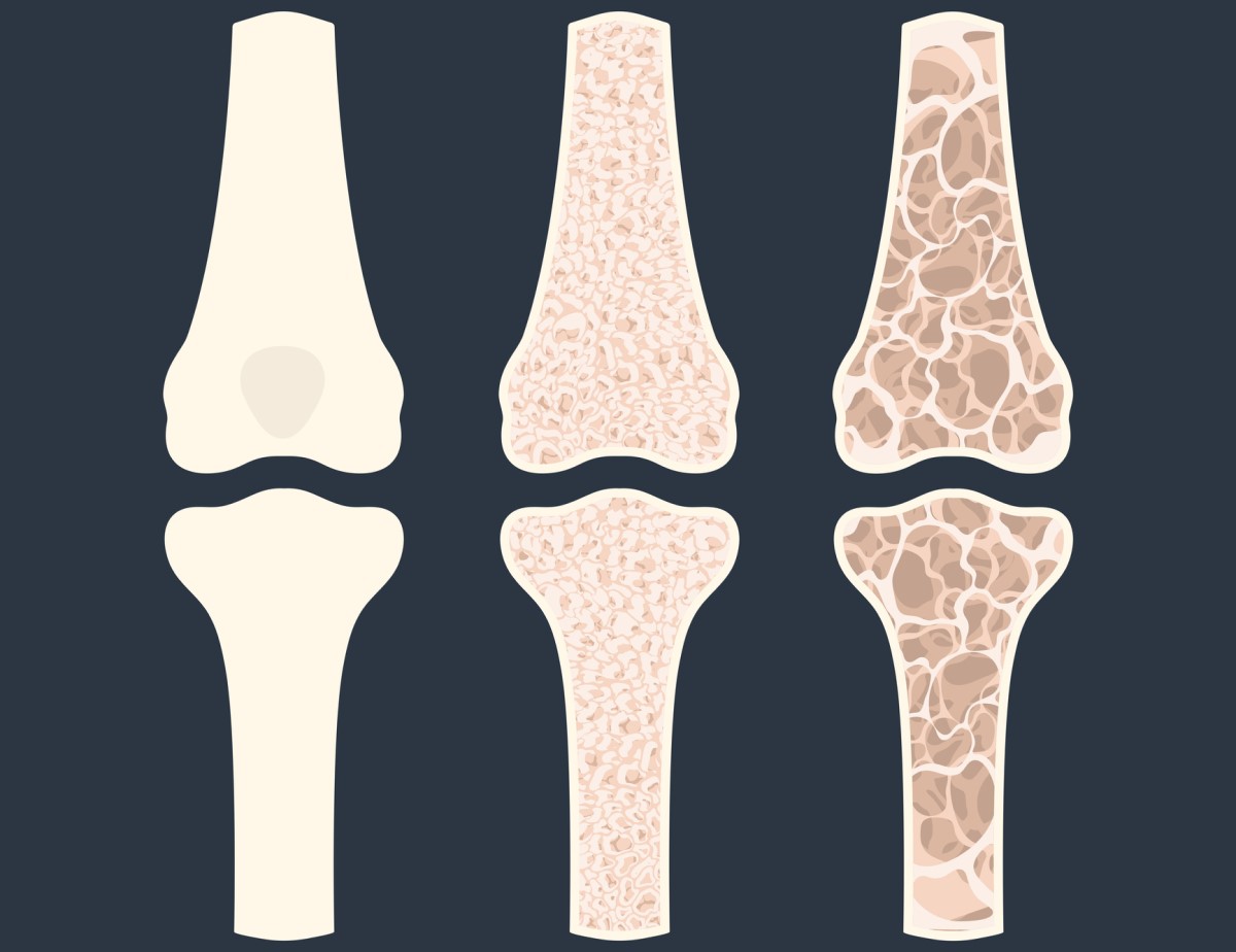 Animasi tiga tulang yang menunjukkan osteoporosis - penipisan tulang