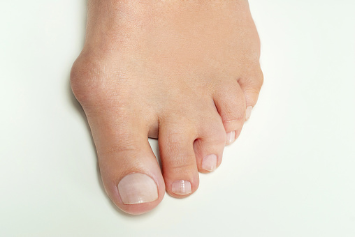 kaki dengan bunion