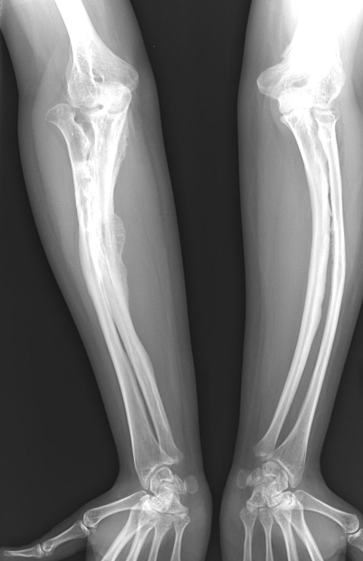 Radiografi penyakit osteogenesis imperfecta pada orang dewasa