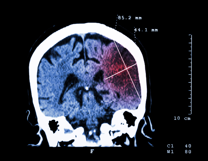 Kerusakan otak terlihat pada CT scan