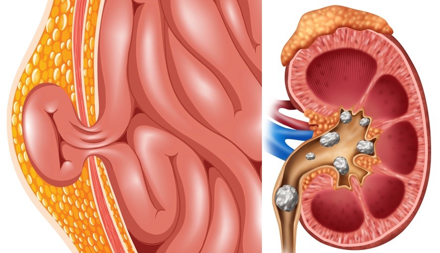 Hernia, ginjal dan batu kemih