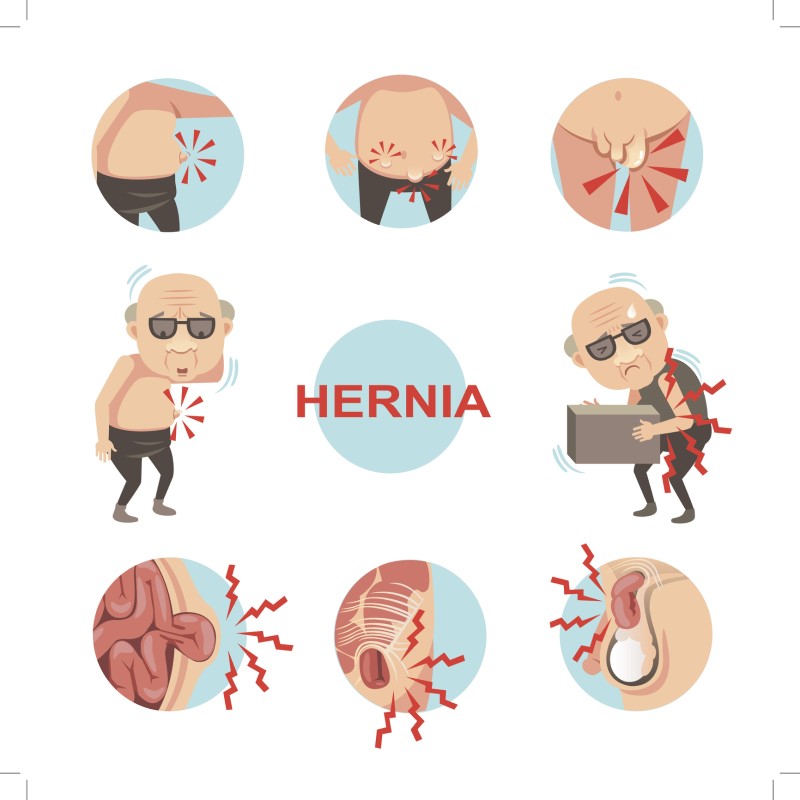 Infografis untuk hernia