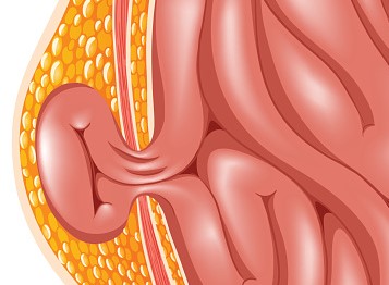 Hernia, komplikasi asites yang paling umum