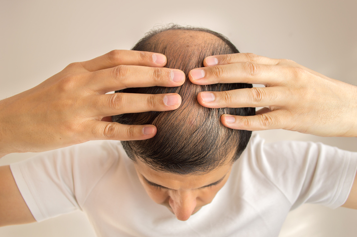 Pria memiliki rambut jarang, rambut rontok, kebotakan, atau alopecia, tangan di atas kepala, tampak atas