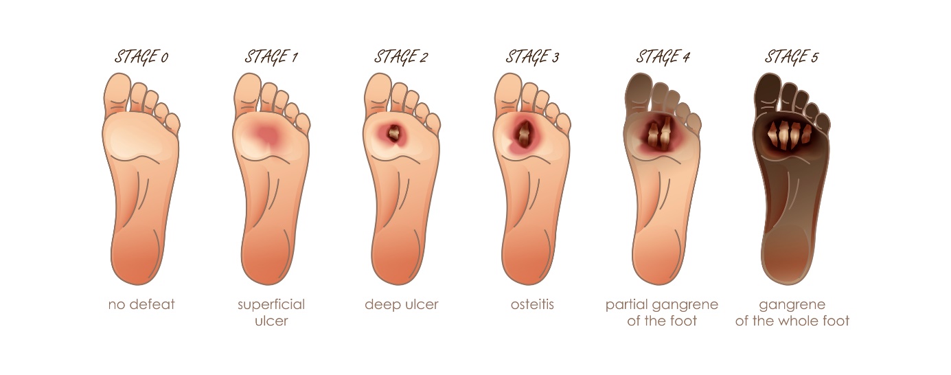 Penyakit ulkus kaki dan tahapannya