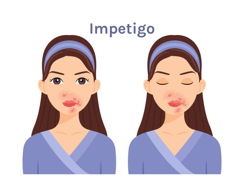 Apa itu impetigo, apa saja gejalanya? Infeksi dan penularan pada anak-anak