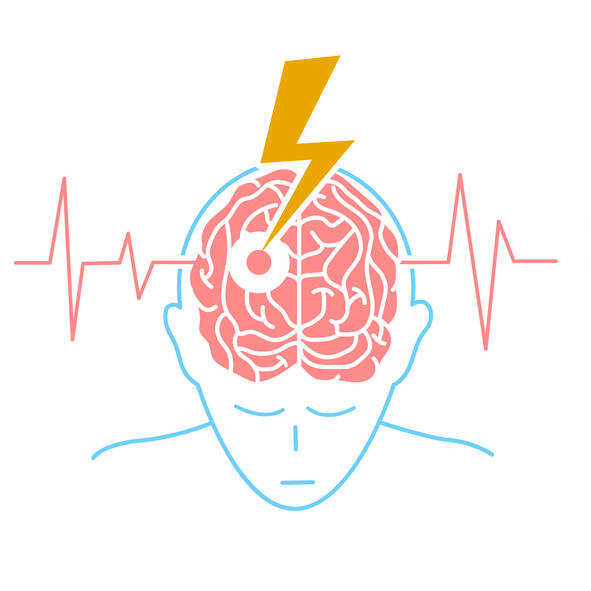 Apa itu stroke? Tahukah Anda gejala, risiko dan pengobatannya?