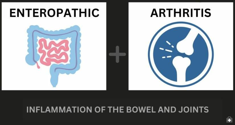 Artritis enteropati dan penyakit radang usus: bagaimana keduanya berhubungan + Gejala