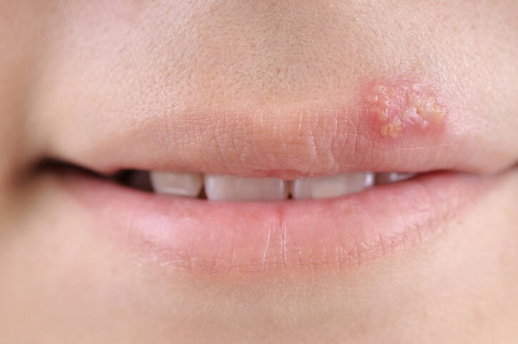 Luka dingin: mengapa herpes terjadi dan apa yang akan membantu dalam pengobatannya (apa untuk luka dingin)?