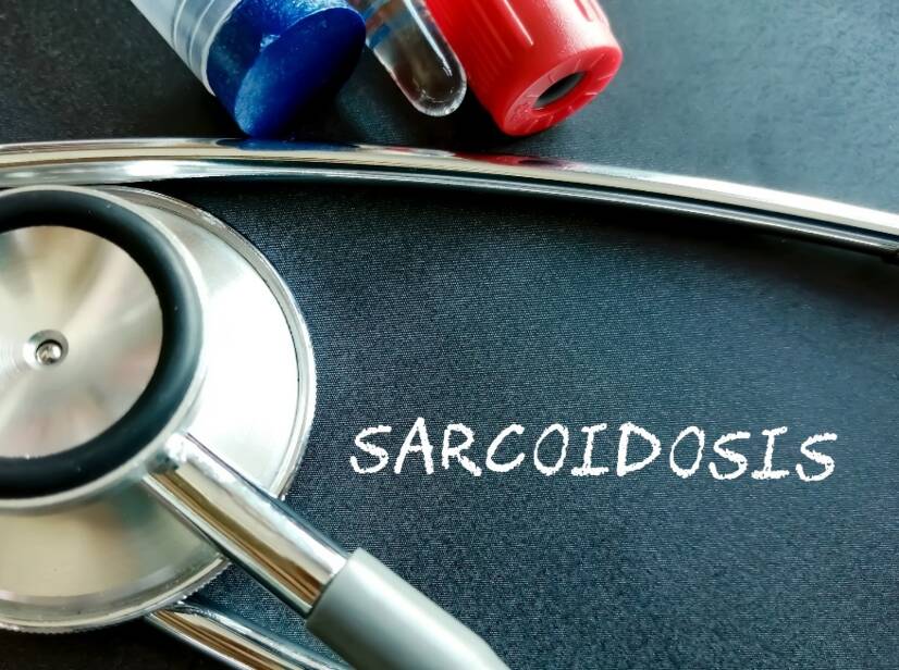 Sarkoidosis: Apa itu sarkoidosis dan apa penyebab/gejalanya? Bentuk paru dan ekstrapulmonal