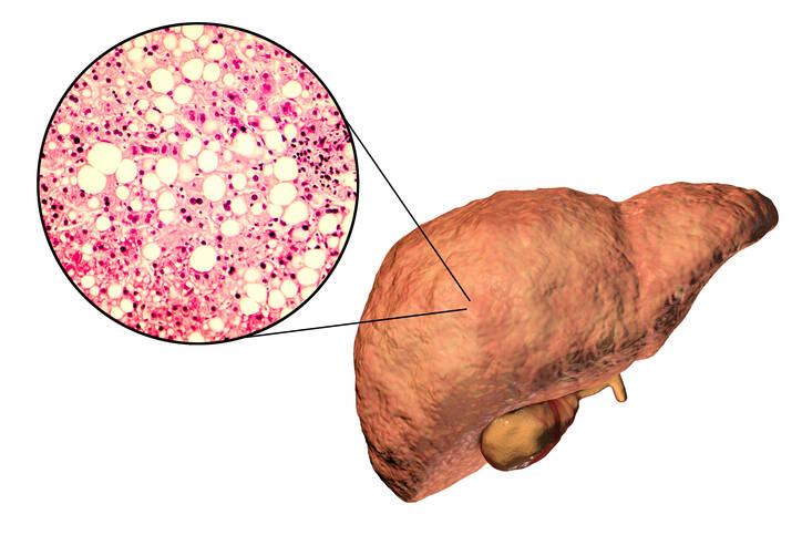 Steatosis hati: apa itu, mengapa timbul dan bagaimana manifestasinya? Bagaimana cara merawat hati?