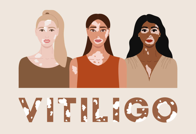 Vitiligo: Apa itu vitiligo dan apa saja penyebab serta gejalanya? Kapan mulai terjadi?