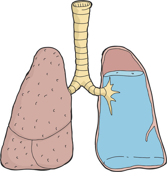 Oedema paru: Mengapa oedema paru terjadi? Apakah ini merupakan penyebab kematian yang umum?