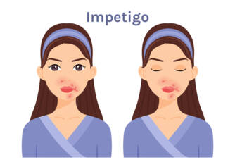 Apa itu impetigo, apa saja gejalanya? Infeksi dan penularan pada anak-anak