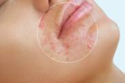 Dermatitis perioral: apa saja gejalanya? Apa saja penyebab penyakit ini?