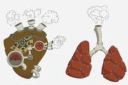 Hipertensi pulmonal: apa itu dan mengapa bisa terjadi? + Gejala dan pengobatan